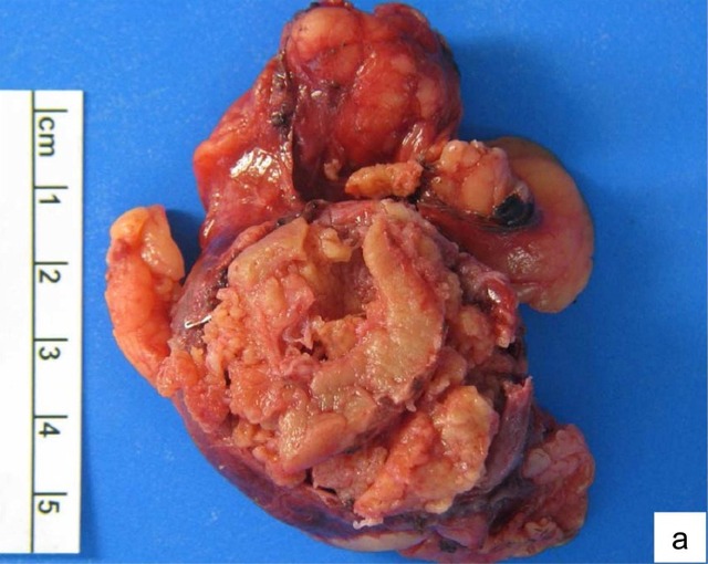 我的左肾得了肾错构瘤,有食疗的方子吗?